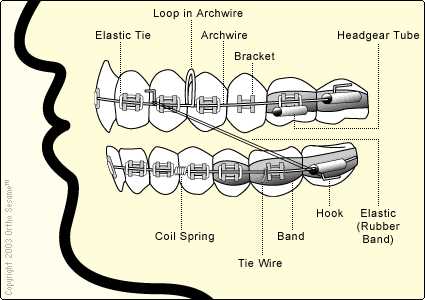 parts of braces diagram