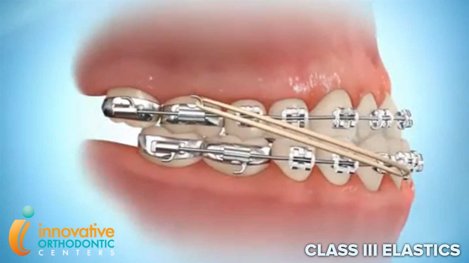 parts of braces diagram