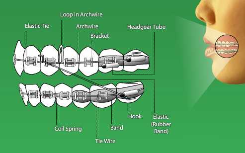 parts of braces diagram