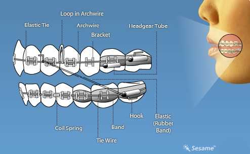 parts of braces diagram