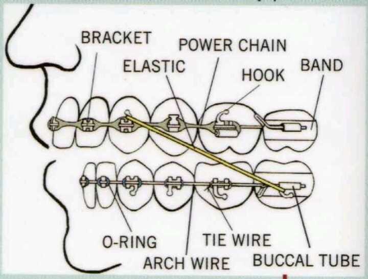 parts of braces diagram