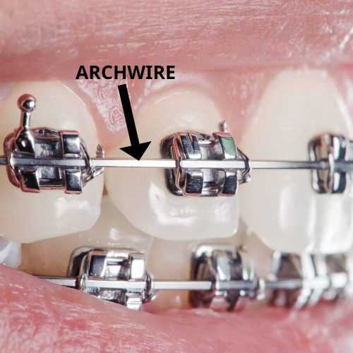 parts of braces diagram