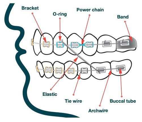 parts of braces diagram