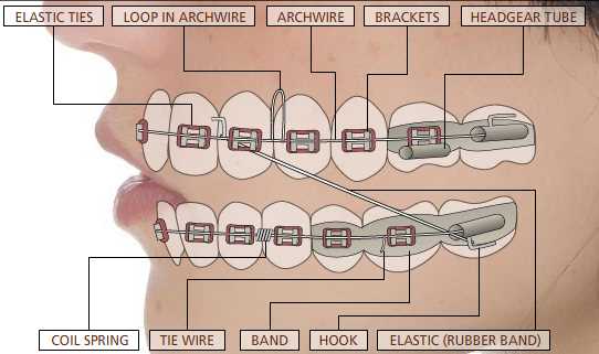 parts of braces diagram