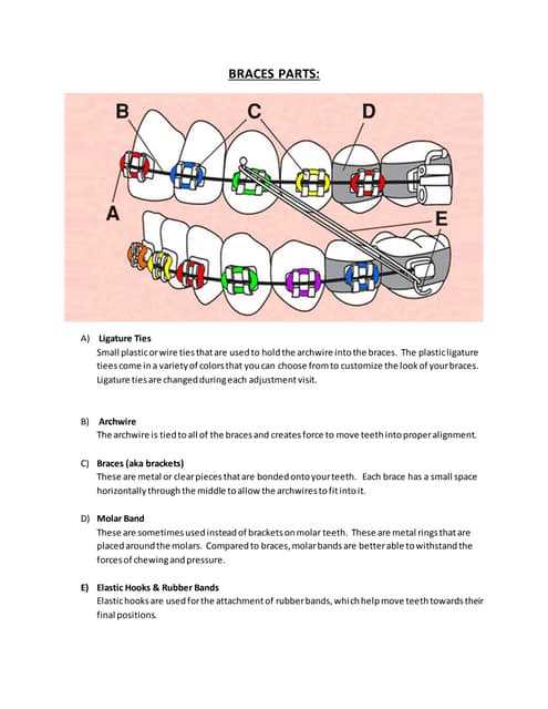 parts of braces diagram