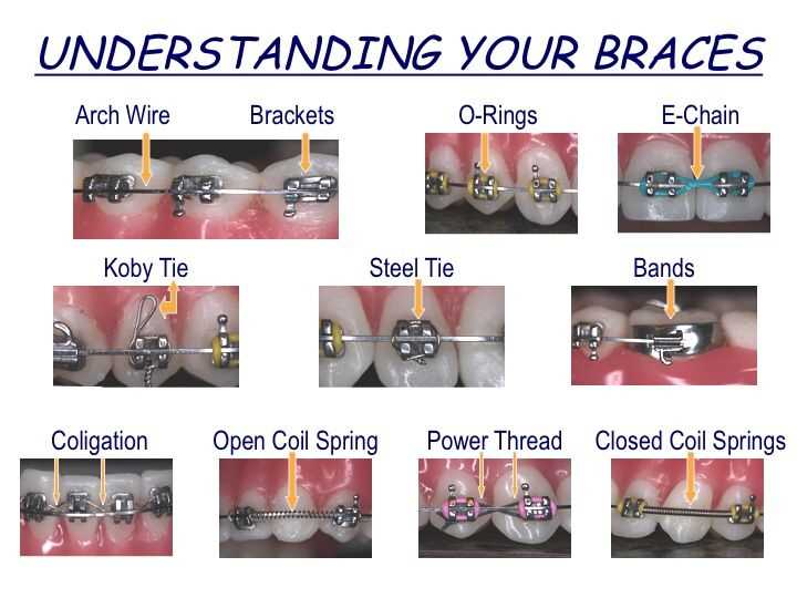 parts of braces diagram