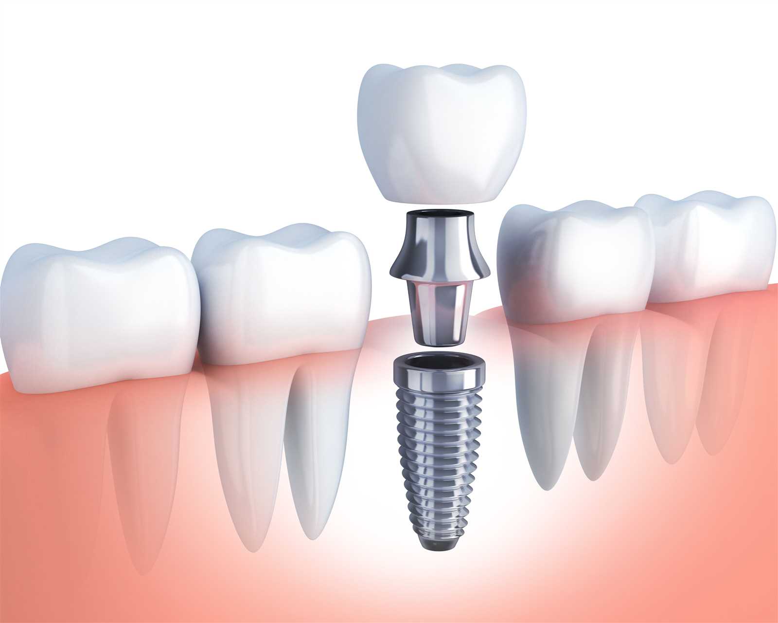 parts of implant diagram