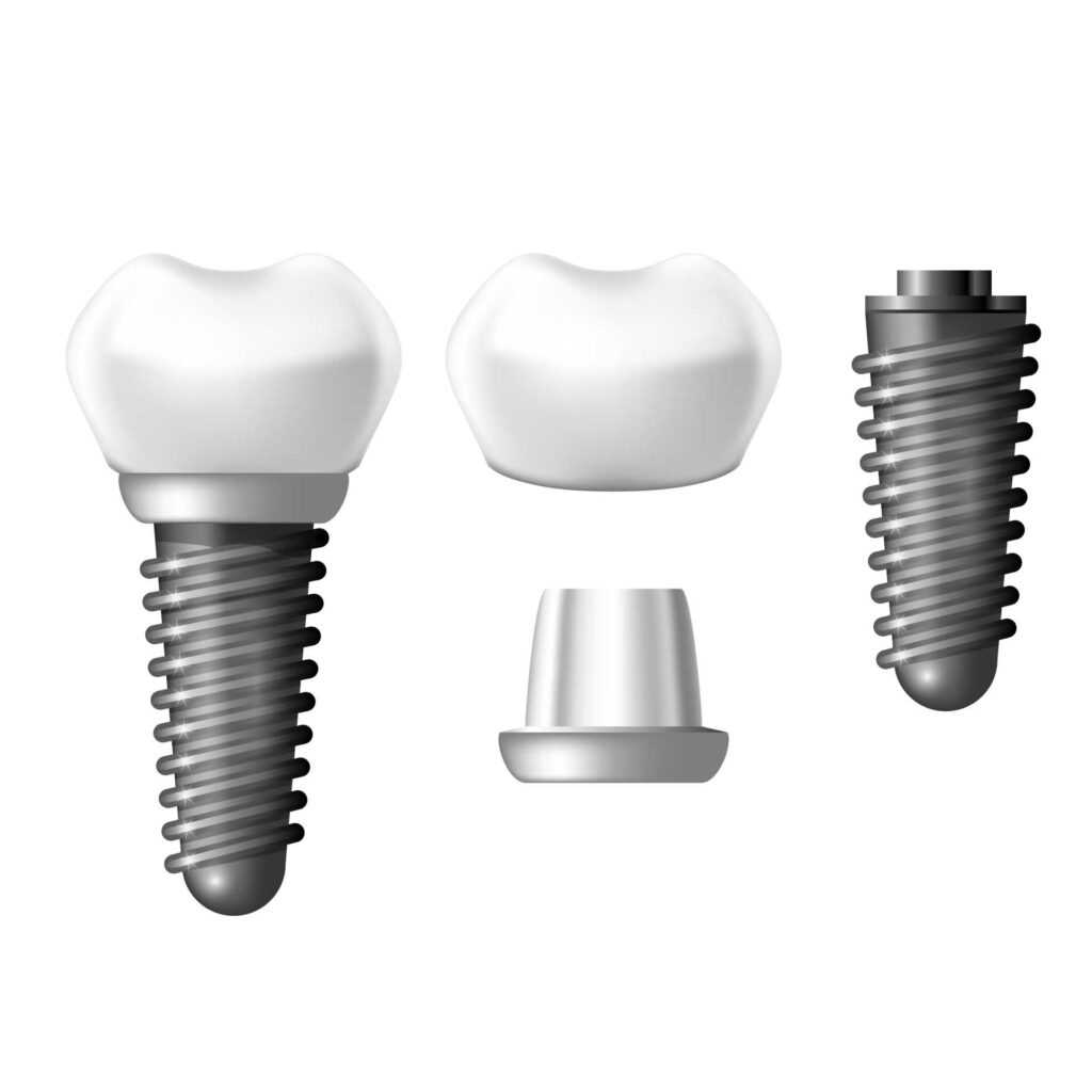 parts of implant diagram