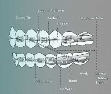 parts of braces diagram